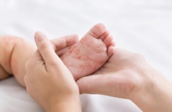 Do not Blame Covid-19 for Current Measles Outbreaks